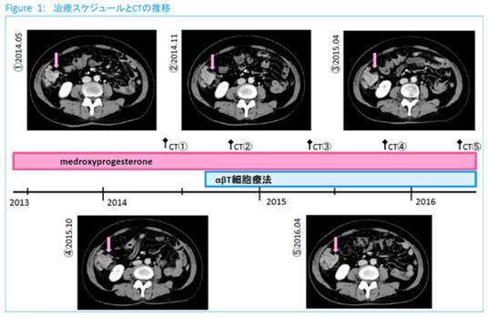 子宮內(nèi)膜癌使用免疫細胞治療效果如何？